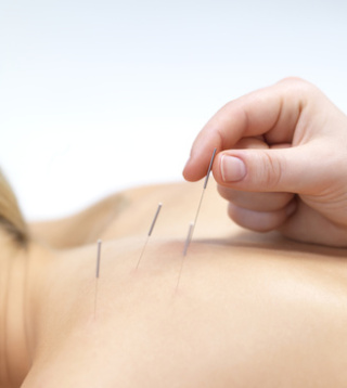 Acupuncture needles on back of a young woman at the spa