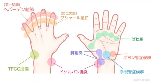 手の痛み⑤5